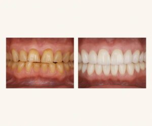 Riabilitazione estetica dentale: prima e dopo il trattamento